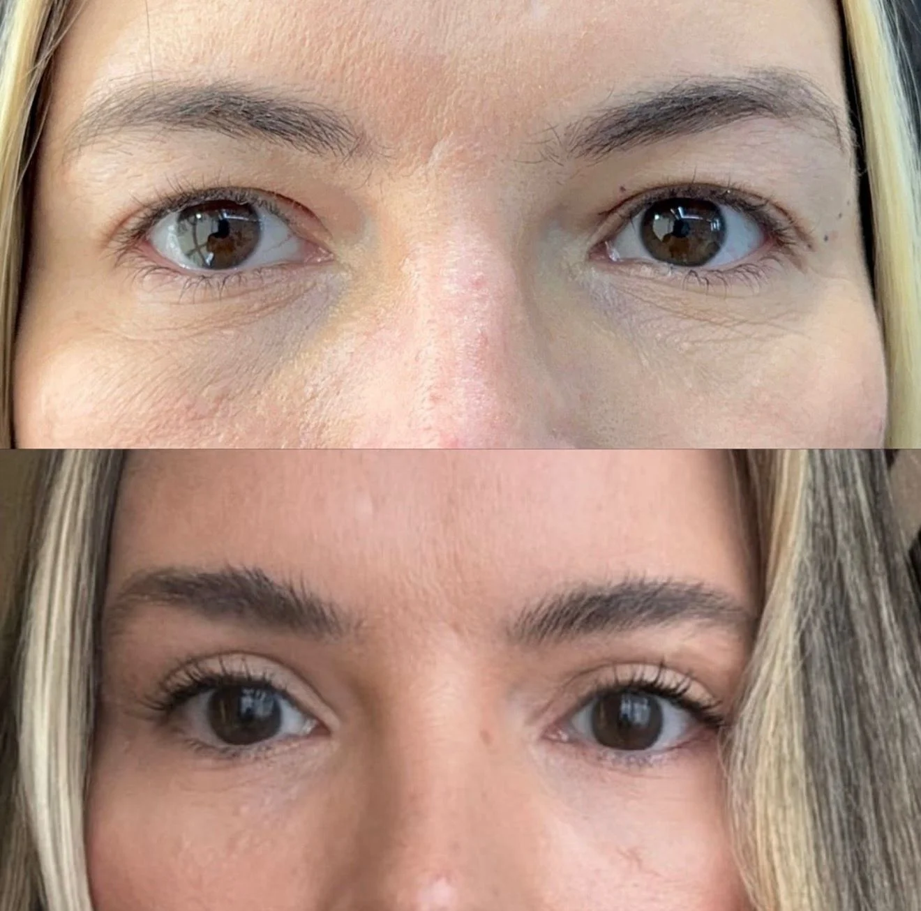Blefaroplastia