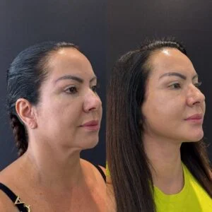 Deep Plane / Face Lifting