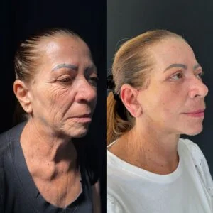 Deep Plane / Face Lifting