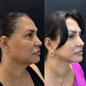 Deep Plane / Face Lifting