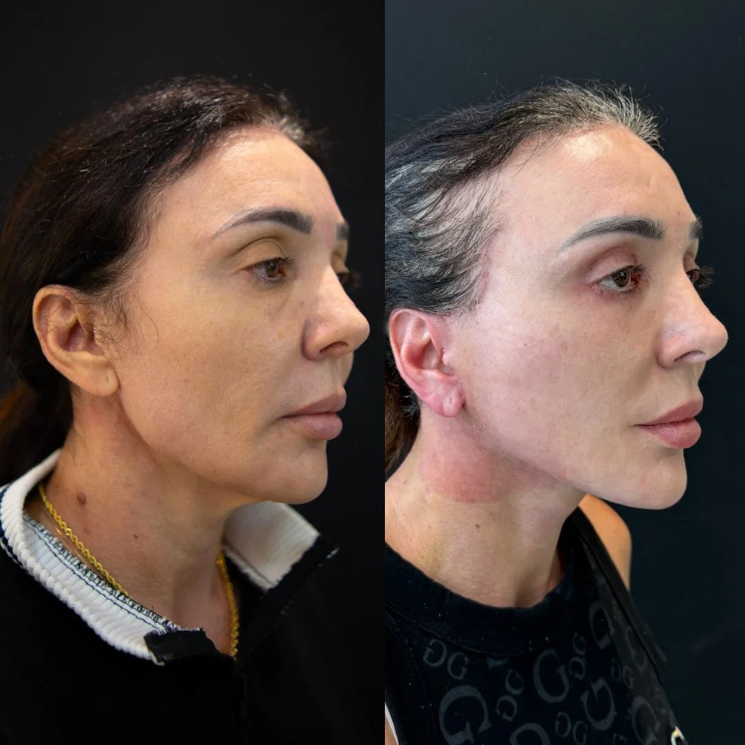 Deep Plane / Face Lifting